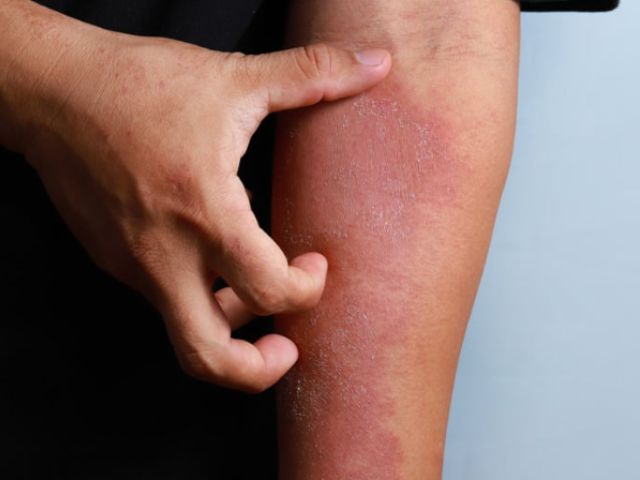 Summer Skin Concerns