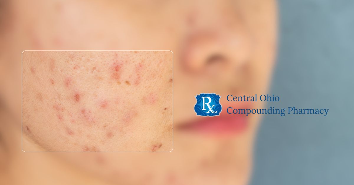 Hormonal Acne in Women: BHRT, Hormone Testing & Compounded Options
