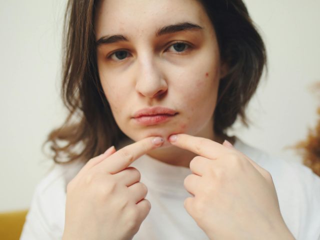 Stress, Certain Foods, and Swinging Weather Also Influence Hormonal Acne